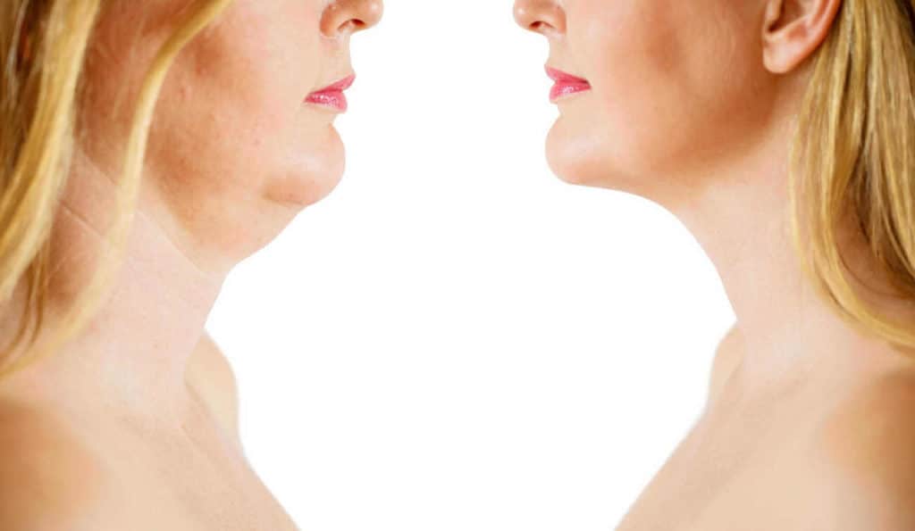 Double Chin treatment Maidstone before and after results