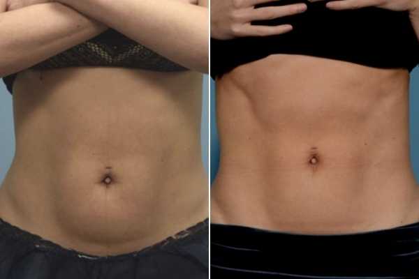 body sculpting FAQs  Maidstone