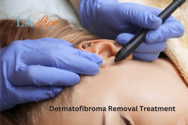 Dermatofibroma Removal Treatment  Maidstone