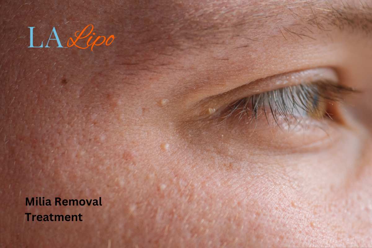 Cryopen Milia Removal: Is It the Easiest and Safest Option  Maidstone?