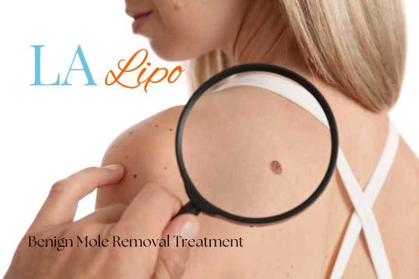 Why getting moles removed Maidstone can boost your confidence!