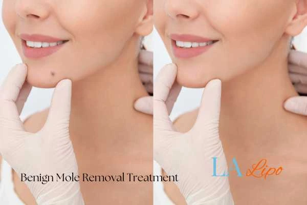 Woman's before and after results of being moles removal treatment Maidstone