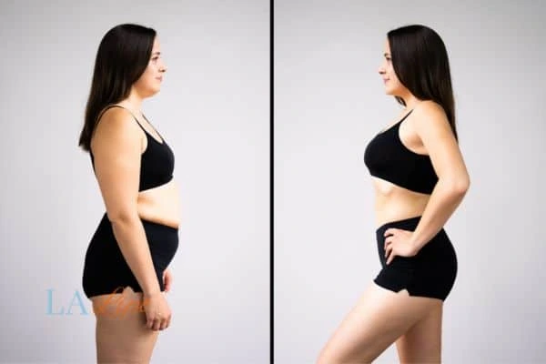 image of woman before and after results of LA-EMS Body Sculpting Maidstone to help treat Diastasis recti