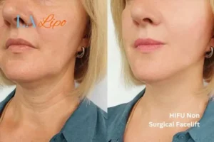 hi-fu for wrinkles Maidstone before and after results