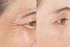 Before and after results of woman - HI-fu wrinkles reduction treatment Maidstone