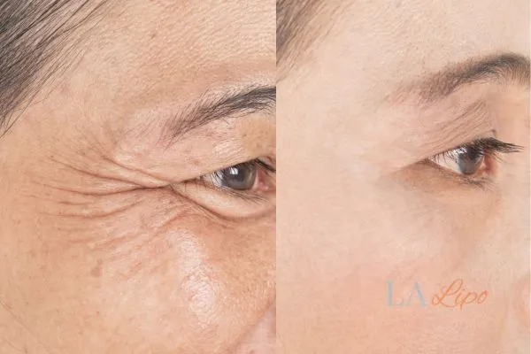 Before and after results of woman - HI-fu wrinkles reduction treatment Maidstone