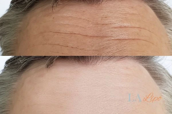 results of HIFU Maidstone on mans forehead to help reduce lines and wrinkles