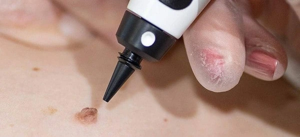 skin tag removal using cryopen  Maidstone