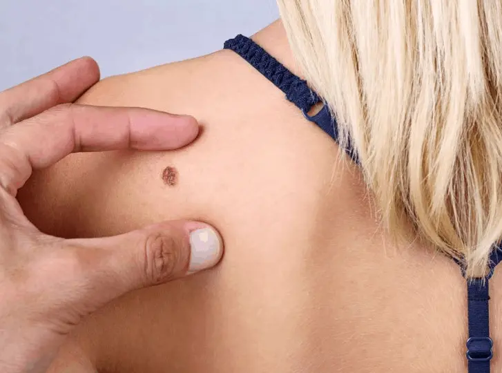 woman having mole removal Maidstone consultation before treatment.