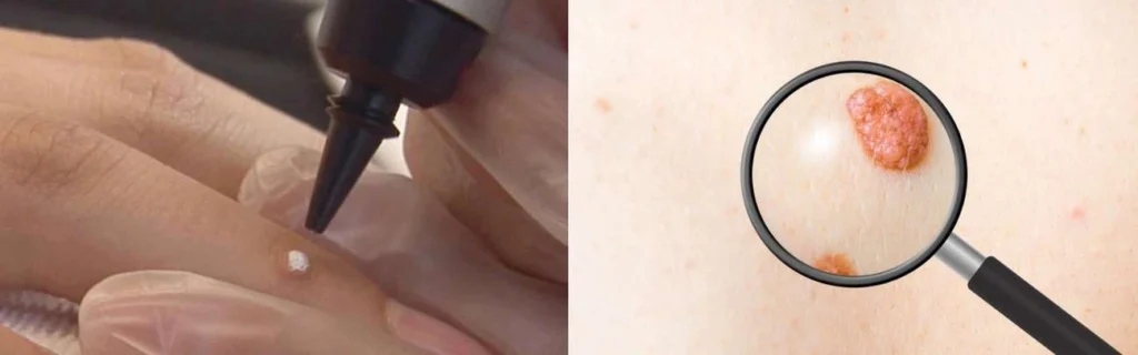 Person getting moles removed with cryopen Maidstone