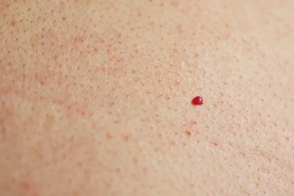 close up of a cherry angioma  Maidstone