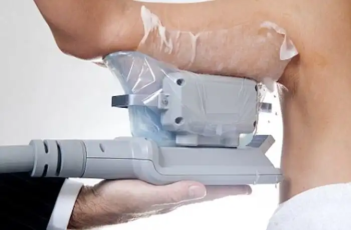 Picture of fat freezing  Maidstone on the upper arms.