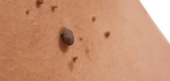 image of a skin tag  Maidstone