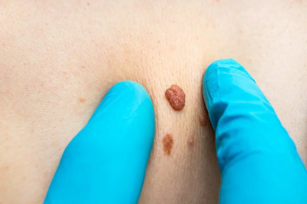 Consultant examining a skin tag  Maidstone