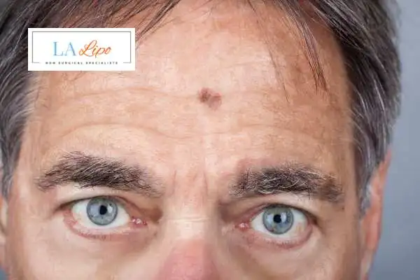 Solar Lentigo Removal Maidstone image of man with mark on his forehead