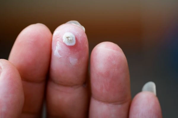 wart on person finger - cryotherapy to treat from LA LIPO Maidstone