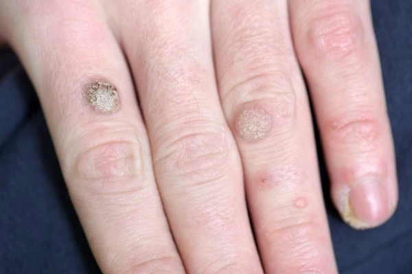 photo of warts on person hand - see wart removal  Maidstone from LA LIPO