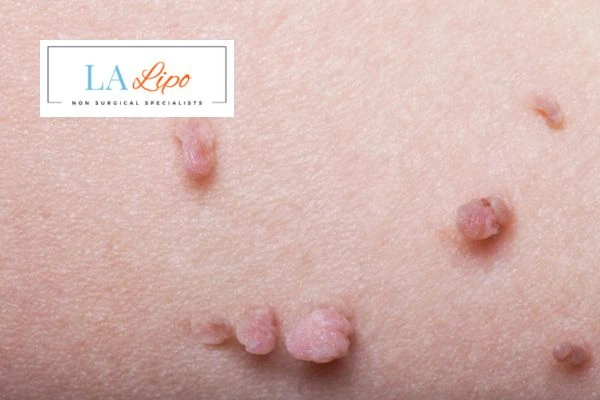 Does cryopen skin tag removal Maidstone hurt? Find out now call our team today!