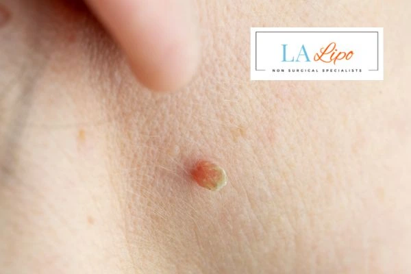 Book skin tag removal Maidstone today speak to our team now!