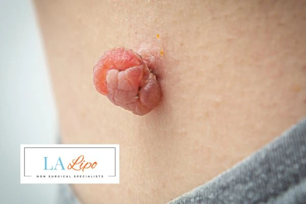 Interested in skin tag removal Maidstone? Concerned about the pain? Find out more today!