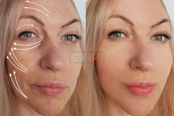 Morpheus 8 results  Maidstone face lift.