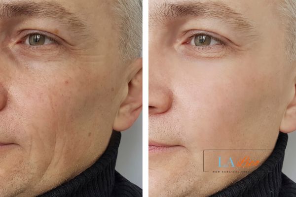 See the amazing results of Morpheus8 Treatment  Maidstone!