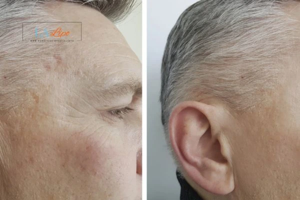 Mens Before & After Morpheus 8 Results  Maidstone