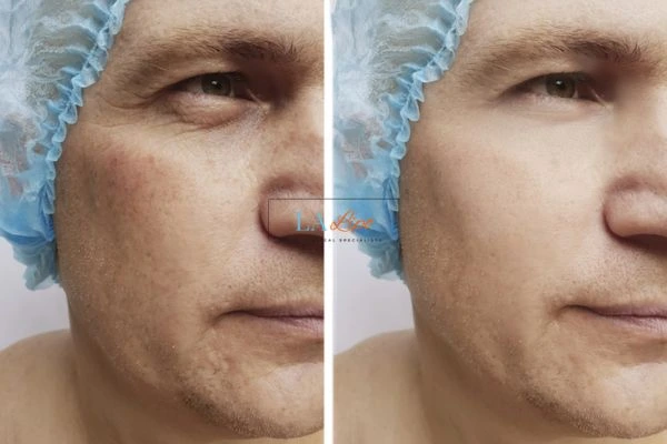 Before and after Morpheus 8 Results  Maidstone
