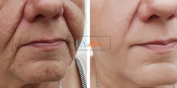 Older lady deeper wrinkle reduction - LA LIPO Morpheus 8 Results  Maidstone