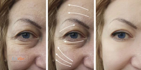 Amazing eye lift Morpheus 8 results  Maidstone