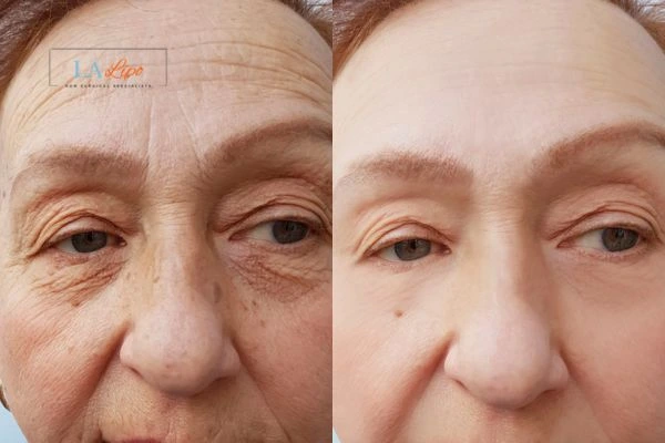 The powerful benefits of Morpheus8 Treatment  Maidstone - Call Our team today!