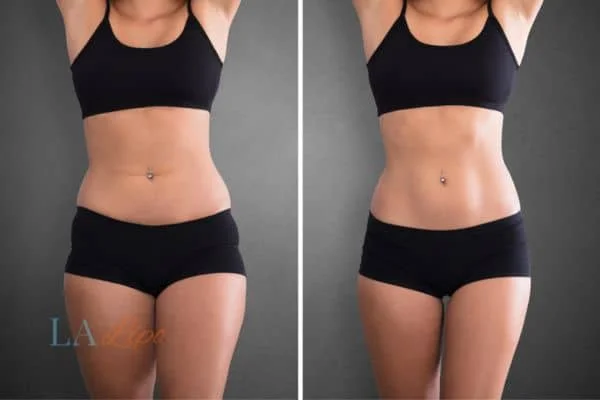 before and after results of non-surgical treatment to help a woman's body image and mental health Maidstone