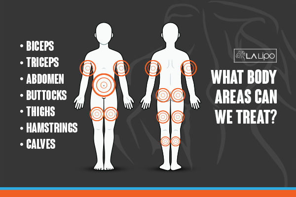 Diagram to show areas you can have LA-EMS Body Sculpting Treatment Maidstone