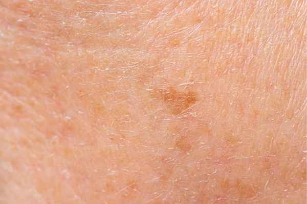 close up picture of age spots Maidstone