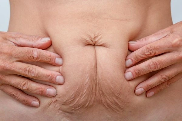 Image of a woman's stomach with loose skin - example of skin tightening Maidstone options
